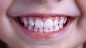 Double rangée de dents chez l’enfant : causes et solutions